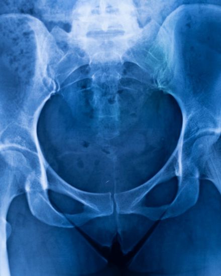 Kalça MR (Pelvis) (Tek Taraflı) resmi